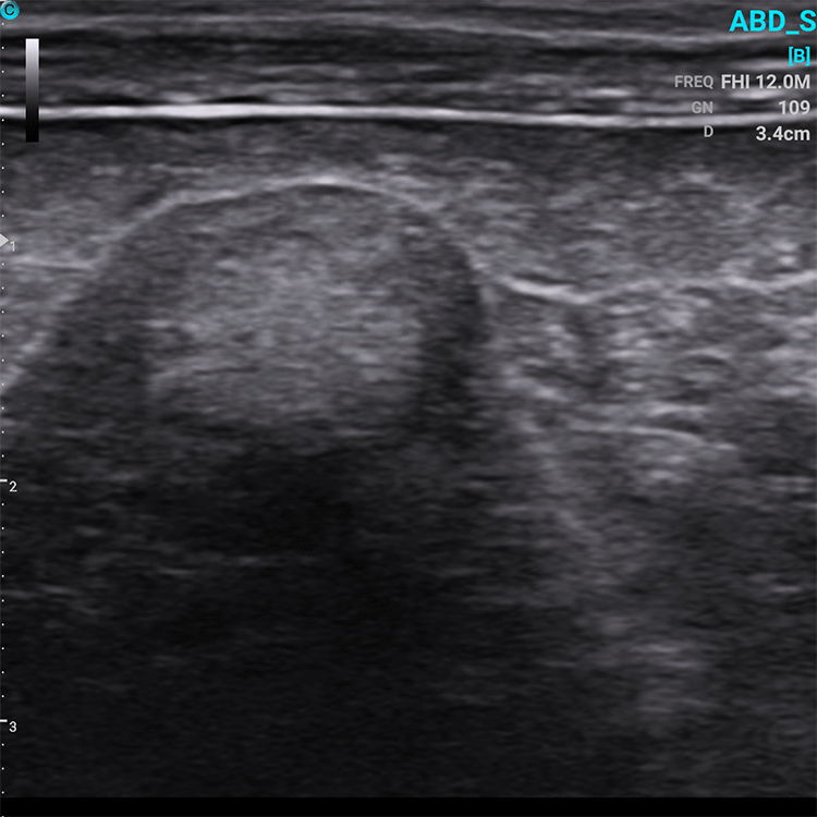 Canine Liver with Hyperechoic structure, B Mode