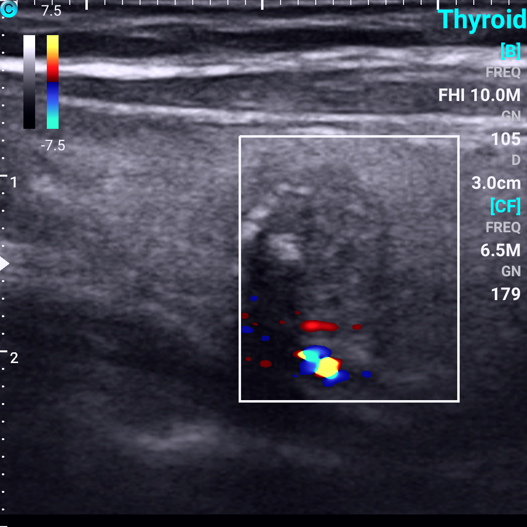 /Thyroid tumor，C Mode